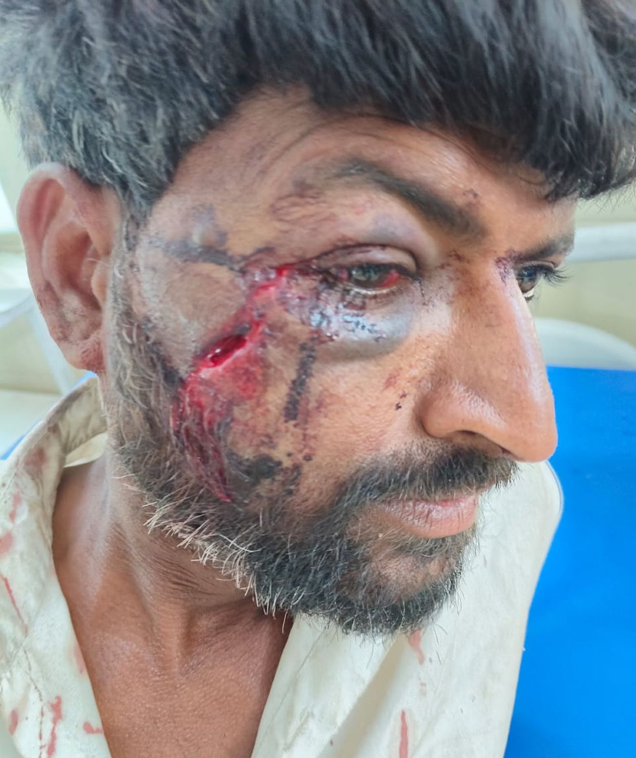 विजयपुर में सनसनी: सो रहे युवक पर पत्थर से हमला